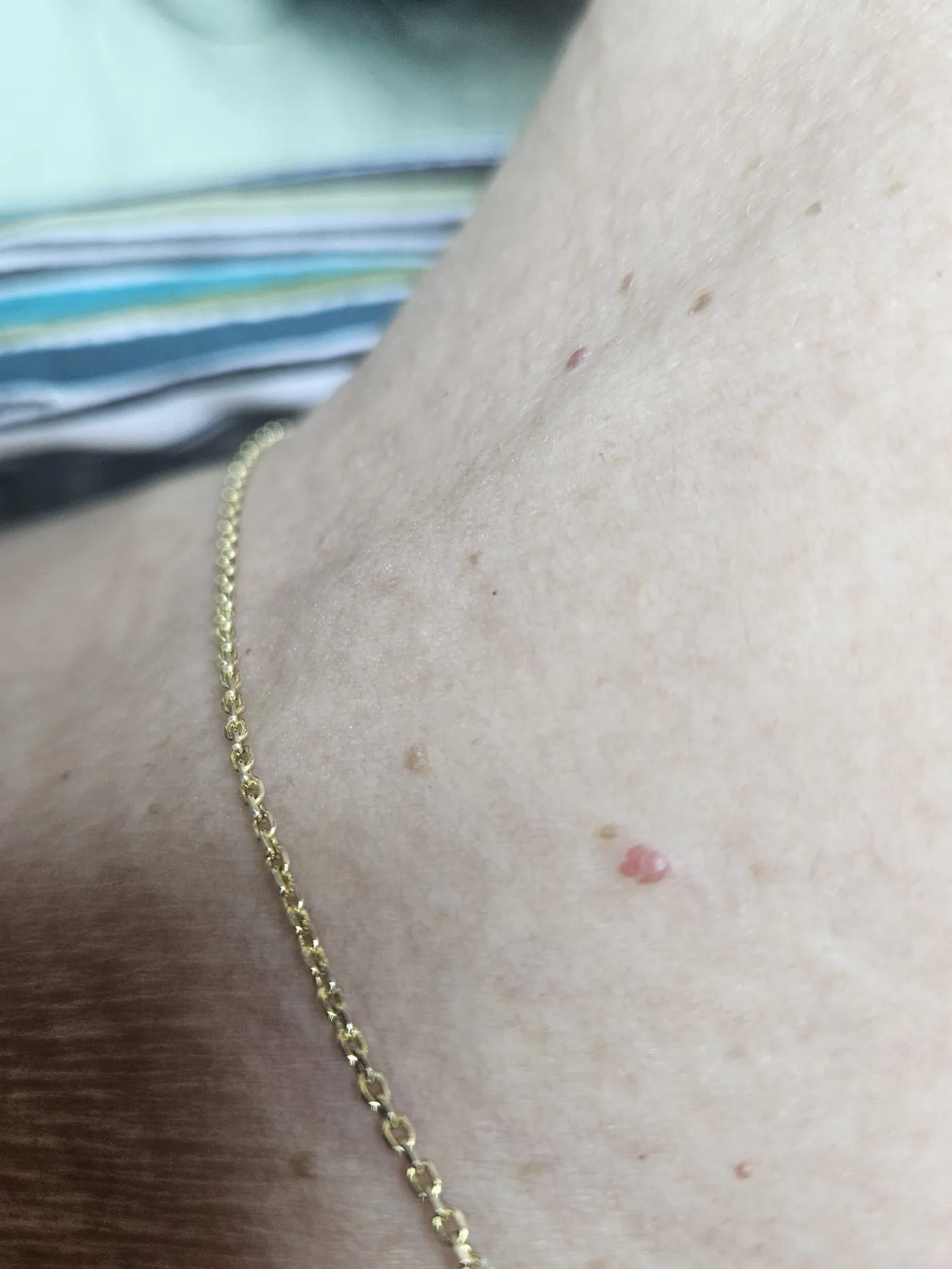 Close-up of a client's upper chest showing several small raised red cherry angiomas before cosmetic removal