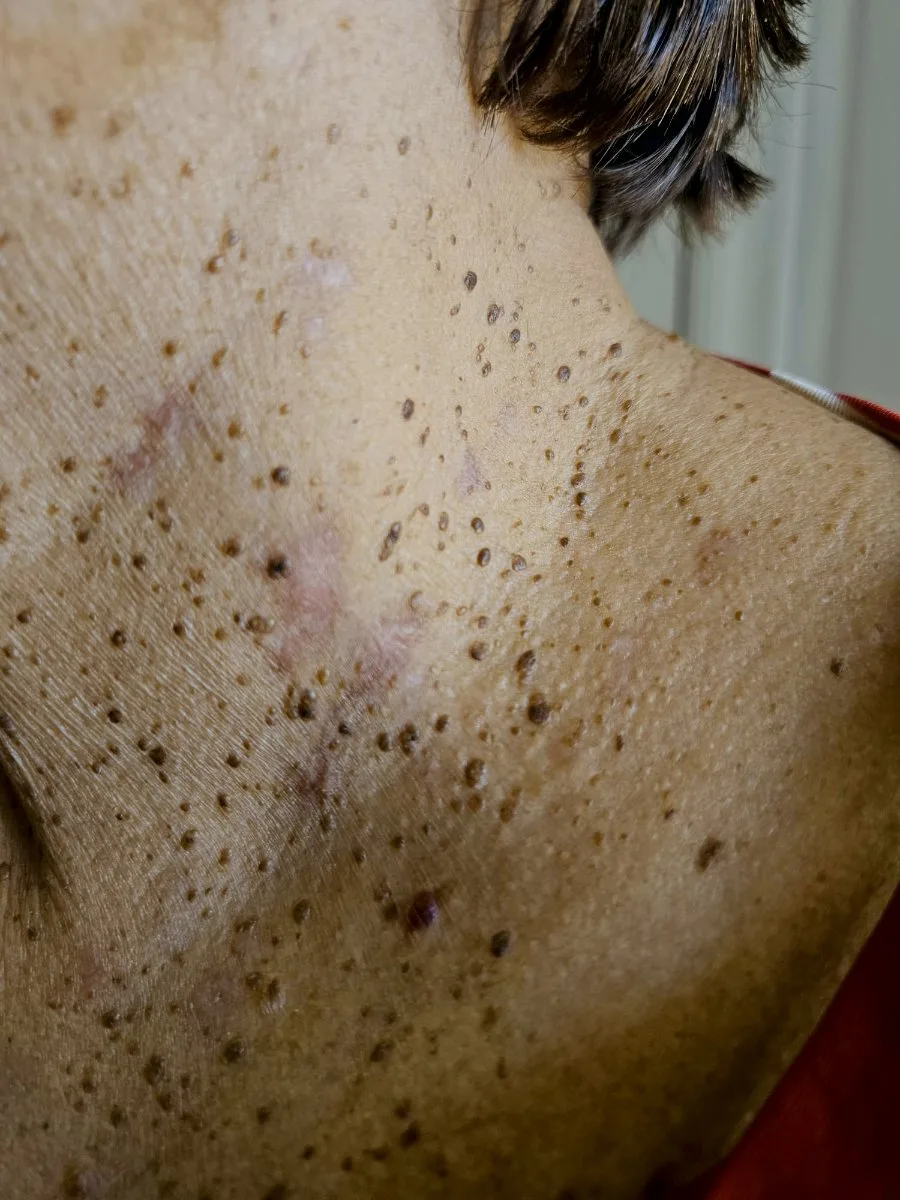 Close-up of a client's neck and shoulder covered in numerous small raised brown seborrheic keratoses