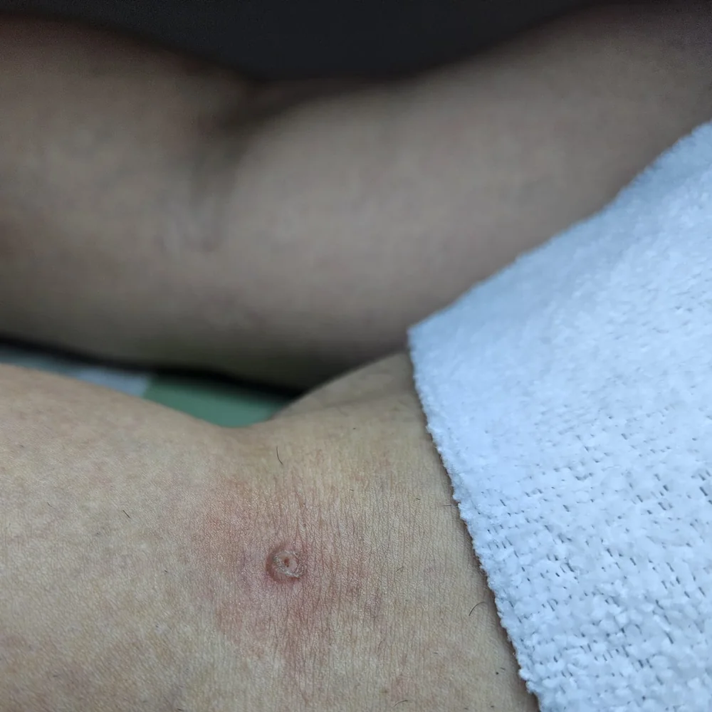 A single soft skin tag near a client’s underarm, and the same spot after cosmetic removal (after)
