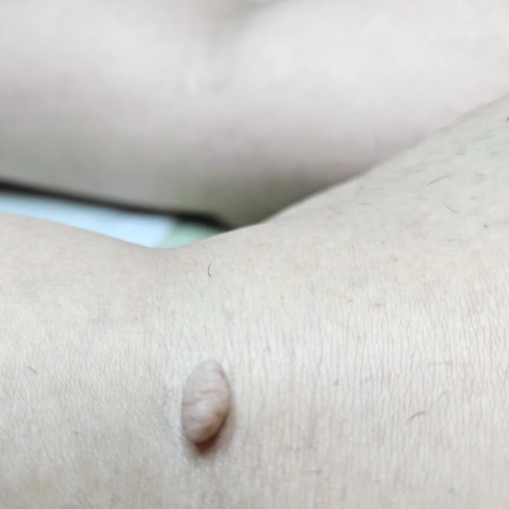 Close-up of a single soft skin tag near a client's underarm, before cosmetic removal